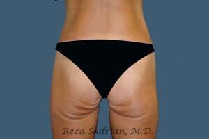 Surgery After Weight Loss Before & After Image