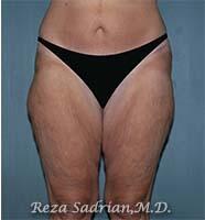 Surgery After Weight Loss Before & After Image
