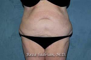 Body Lift Before & After Image