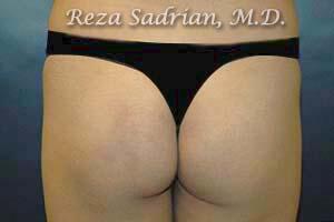 Brazilian Butt Lift Before & After Image