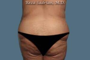 Brazilian Butt Lift Before & After Image