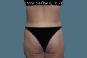 Brazilian Butt Lift Before & After Image