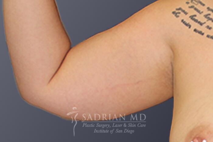 Liposuction Before & After Image