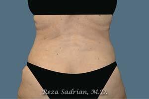 Liposuction Before & After Image