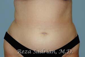 Liposuction Before & After Image