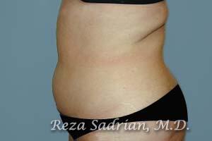 Liposuction Before & After Image