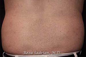 Liposuction Before & After Image