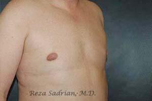 Male Body Enhancement Before & After Image