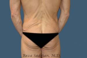 Male Body Enhancement Before & After Image