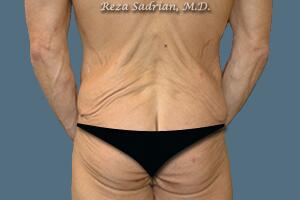 Male Body Enhancement Before & After Image