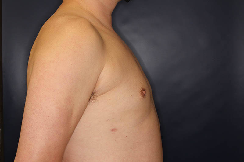 Male Body Enhancement Before & After Image