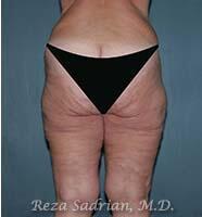 Thigh Lift Before & After Image
