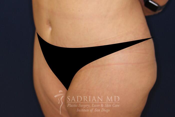 Tummy Tuck Before & After Image