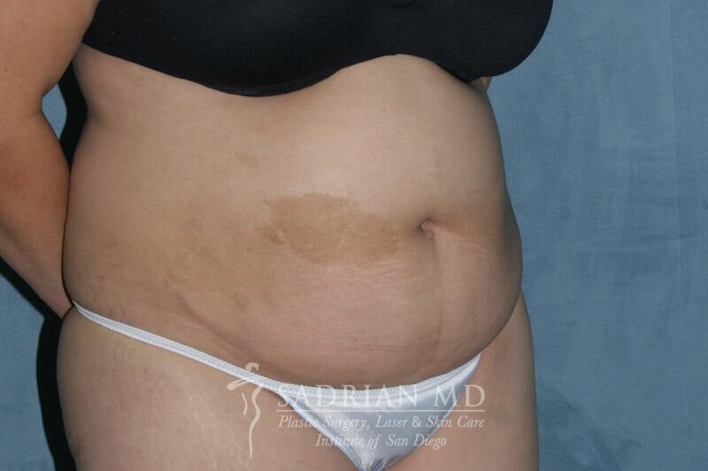 Tummy Tuck Before & After Image