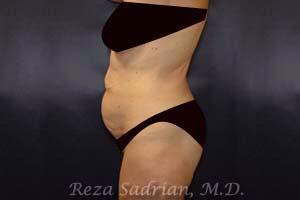 Tummy Tuck Before & After Image