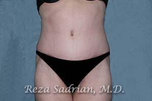 Tummy Tuck Before & After Image