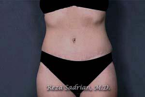 Tummy Tuck Before & After Image