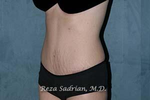 Tummy Tuck Before & After Image