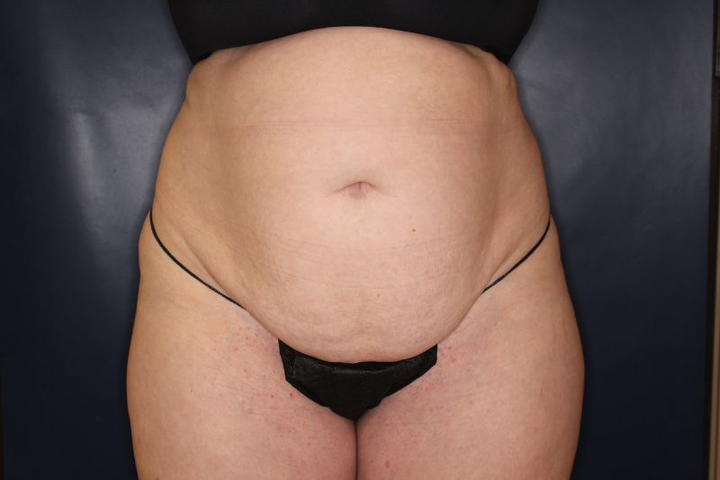Tummy Tuck Before & After Image
