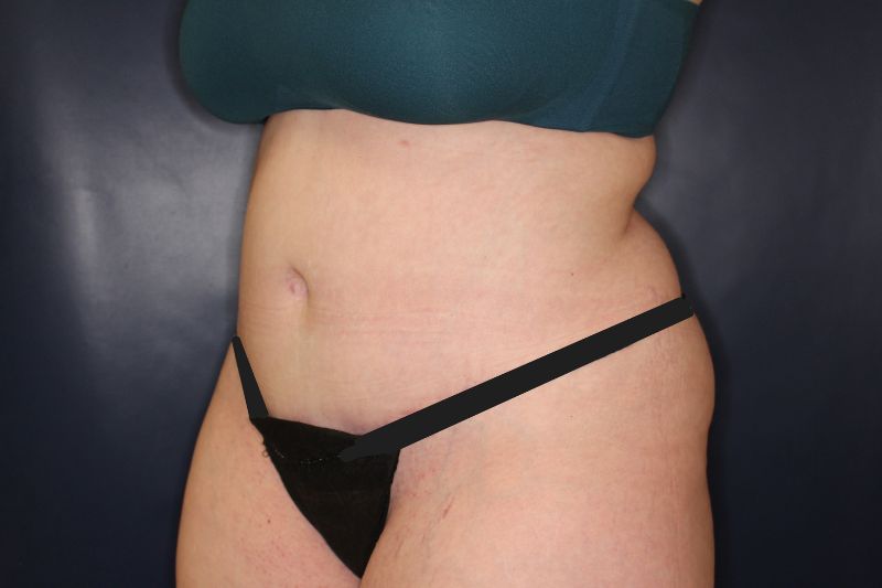 Tummy Tuck Before & After Image