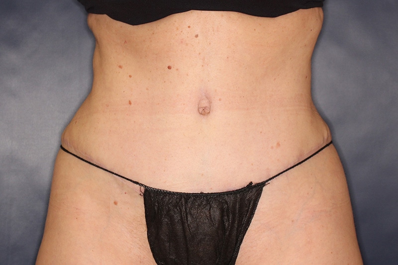 Tummy Tuck Before & After Image