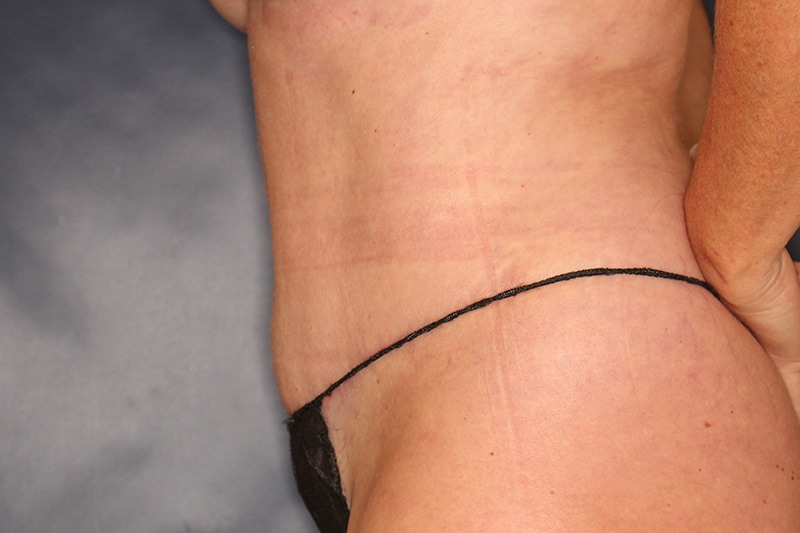 Tummy Tuck Before & After Image