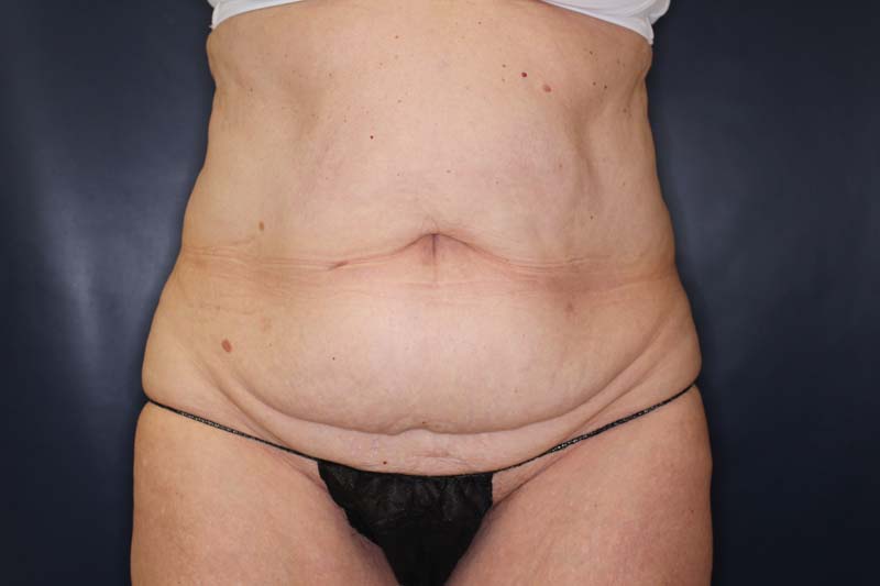 Tummy Tuck Before & After Image