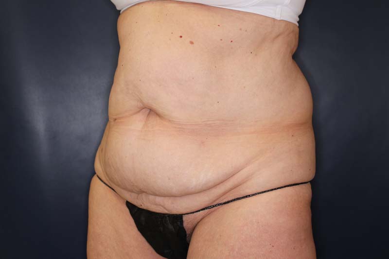 Tummy Tuck Before & After Image
