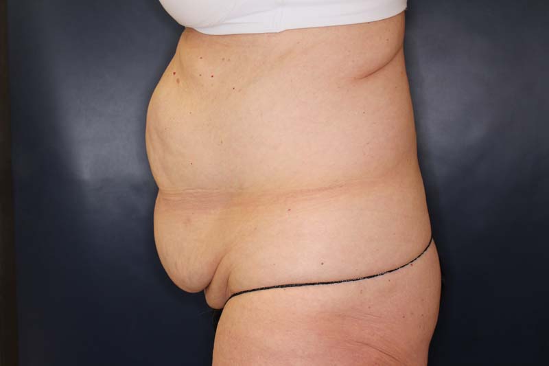 Tummy Tuck Before & After Image