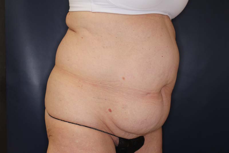 Tummy Tuck Before & After Image