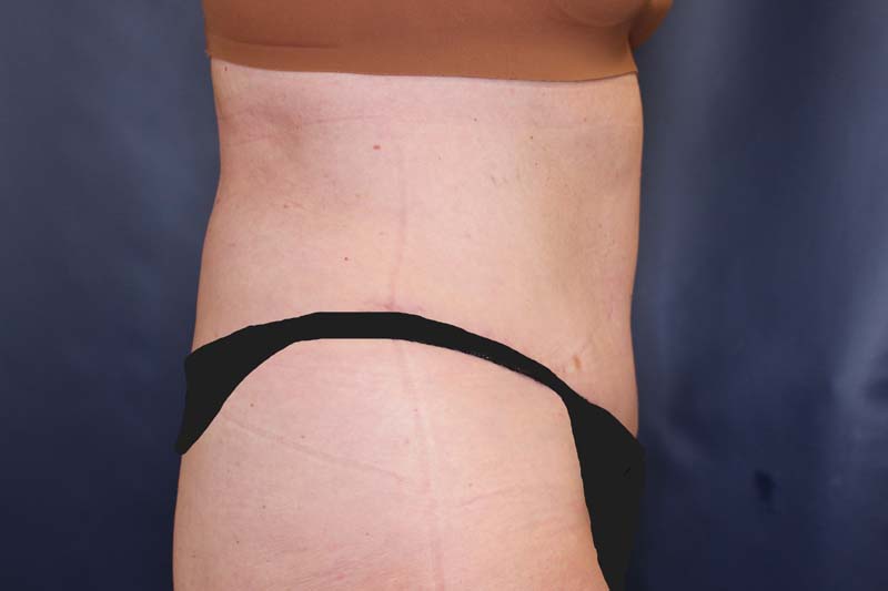 Tummy Tuck Before & After Image