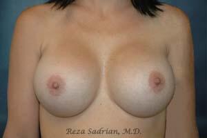 Breast Asymmetry Correction Before & After Image