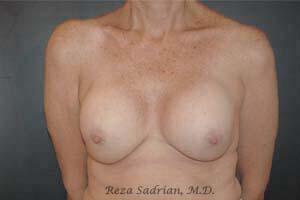 Breast Asymmetry Correction Before & After Image