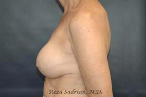Breast Asymmetry Correction Before & After Image