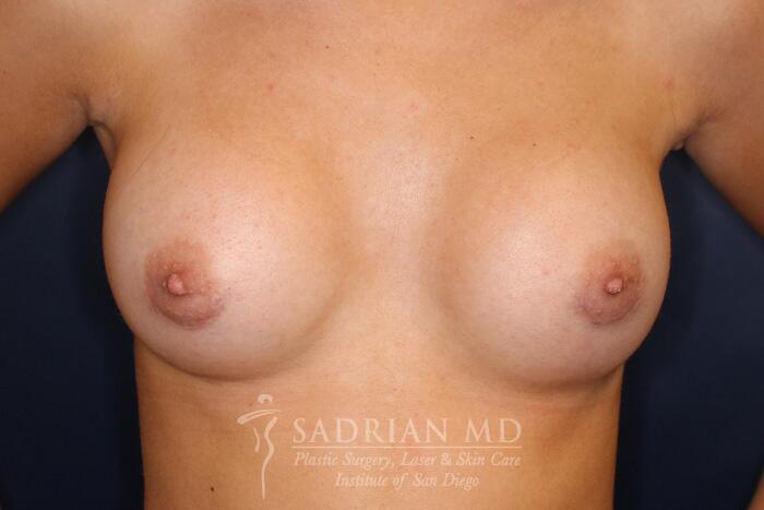 Breast Augmentation Before & After Image