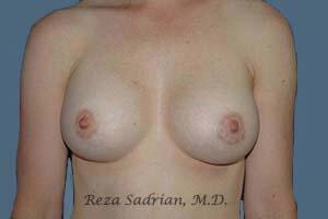 Breast Augmentation Before & After Image
