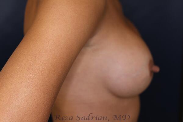 Breast Augmentation Before & After Image