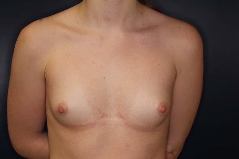 Breast Augmentation Before & After Image