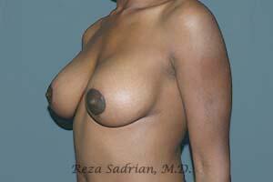 Breast Augmentation with Lift Before & After Image