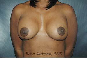 Breast Augmentation with Lift Before & After Image
