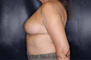 Breast Reduction Before & After Image