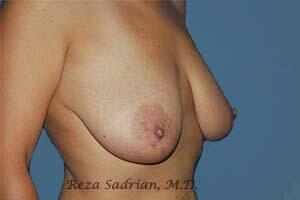 Breast Reduction Before & After Image