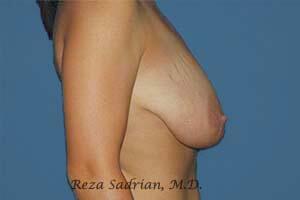 Breast Reduction Before & After Image