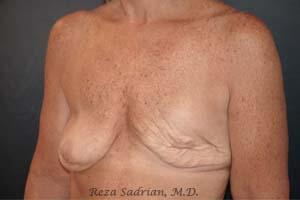Breast Revision Before & After Image