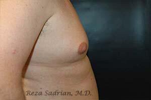 Gynecomastia Before & After Image