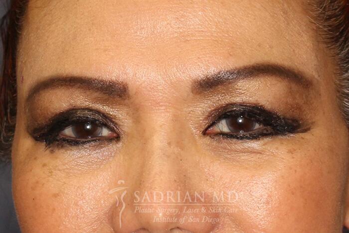 Blepharoplasty Before & After Image
