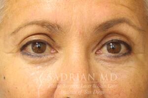 Blepharoplasty Before & After Image