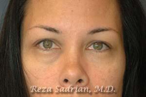 Blepharoplasty Before & After Image