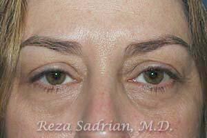 Blepharoplasty Before & After Image
