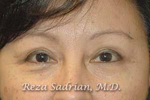 Blepharoplasty Before & After Image